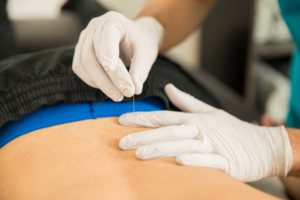 A therapist performing dry needling for back pain.